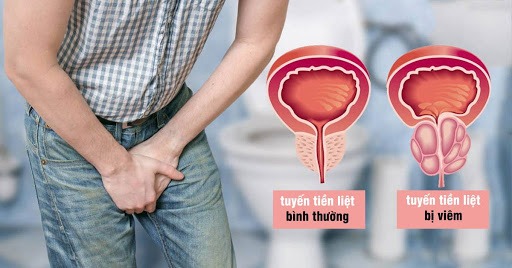 Khám viêm tuyến tiền liệt ở đâu uy tín Hà Nội