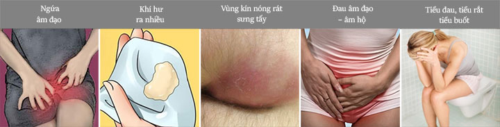 nhận biết sớm nấm vùng kín bằng 5 dấu hiệu đặc trưng sau