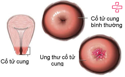 khi-hu-mau-nau-khong-mui