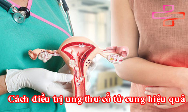 Cách điều trị ung thư cổ tử cung hiệu quả