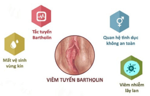 Nguyên nhân viêm tuyến Bartholin