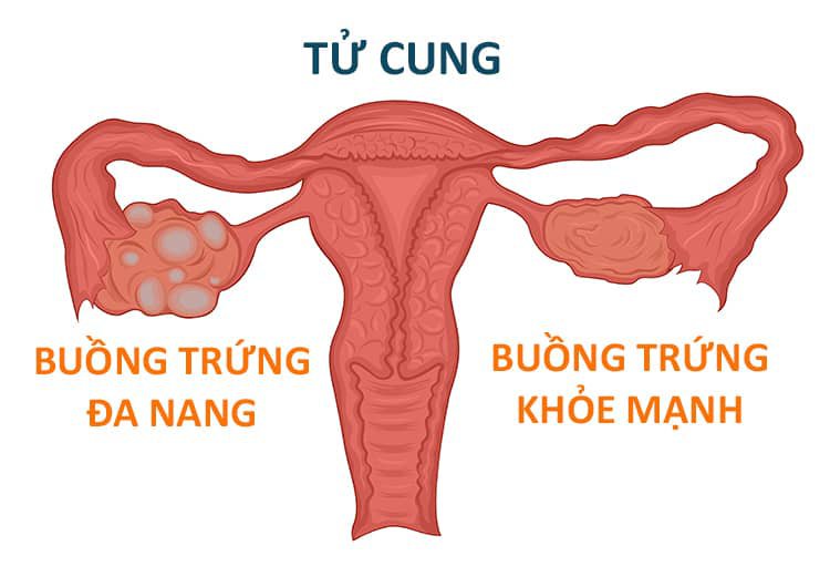 đa nang buồng trứng