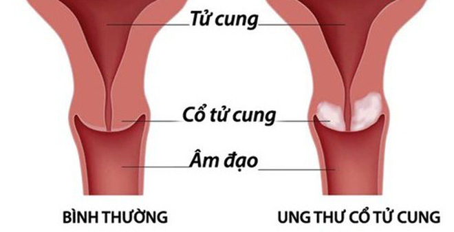 hình ảnh ung thư cổ tử cung