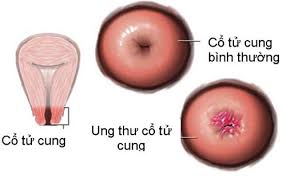 Hiện tượng ung thư cổ tử cung