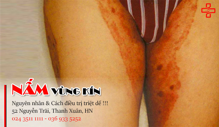 nấm vùng kín ở nữ