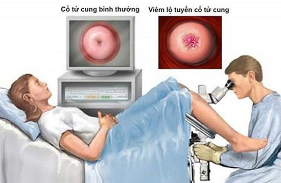 Đốt viêm lộ tuyến là gì?